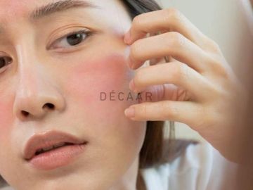 #Peel Da Bị Ngứa Phải Làm Gì? Hướng dẫn Chăm Sóc Da Sau Peel