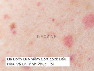 Da Body Bị Nhiễm Corticoid: Dấu Hiệu Và Lộ Trình Phục Hồi
