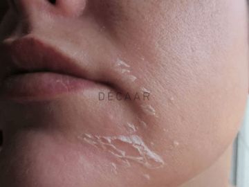 Chăm sóc da sau peel để phục hồi nhanh