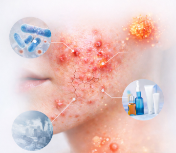 Mụn dai dẳng, kháng trị: Giải mã cơ chế cùng hai hướng điều trị đúng bản chất