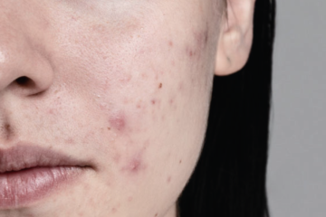 5 bước skincare cho da dầu mụn mùa nóng chuẩn chuyên gia