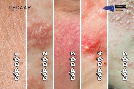 Cách Thải Độc Da Nhiễm Corticoid Tại Nhà Hiệu Quả, An Toàn
