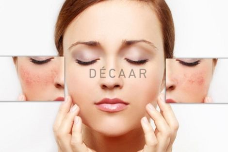 Các Cách Trị Nám Da Mặt Hiệu Quả Và Tốt Nhất Hiện Nay