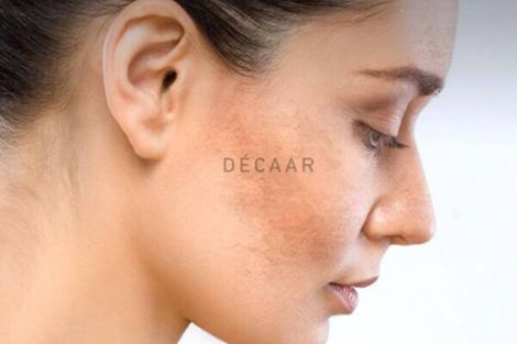 Các Liệu Trình Điều Trị Nám Da, Tàn Nhang Hot Nhất Hiện Nay