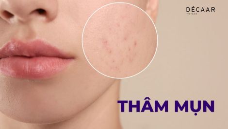 5+ Kem Trị Mụn Thâm Được Tin Dùng Nhiều Nhất Hiện Nay