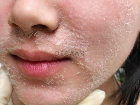 #So Sánh Phương Pháp Peel Bong Tróc Và Peel Không Bong Tróc