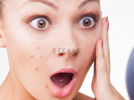 #Mụn Viêm Ở Má - Cách Điều Trị Và Chăm Sóc Từ A-Z