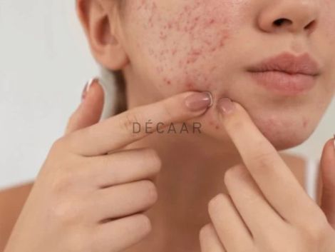 #Bị Mụn Ở Cằm Có Phải Do Rối Loạn Nội Tiết Không?