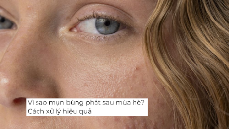 Vì sao mụn bùng phát sau mùa hè? Cách xử lý hiệu quả