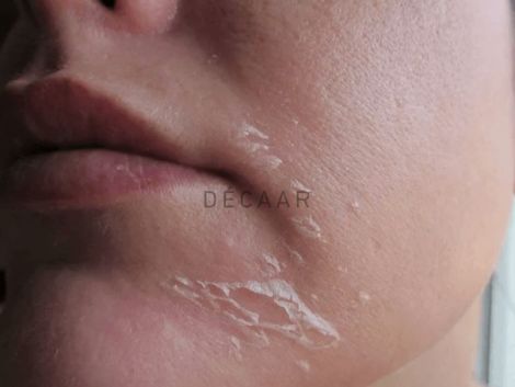 Chăm sóc da sau peel để phục hồi nhanh