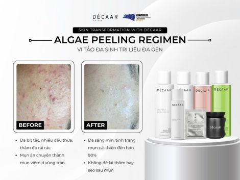 Review Peel Da với Sản Phẩm Décaar: Trải Nghiệm Peel Sinh Học Tại Nhà