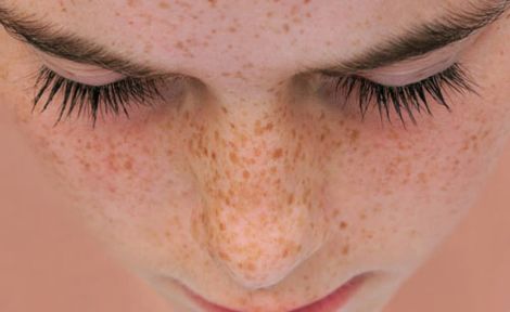 VÌ SAO ĐIỀU TRỊ SẠM PHẢI BẮT ĐẦU TỪ PHỤC HỒI HÀNG RÀO DA?