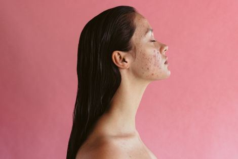Routine chăm sóc da mụn tạI nhà giúp kéo dàI hiệu quả sau treatment