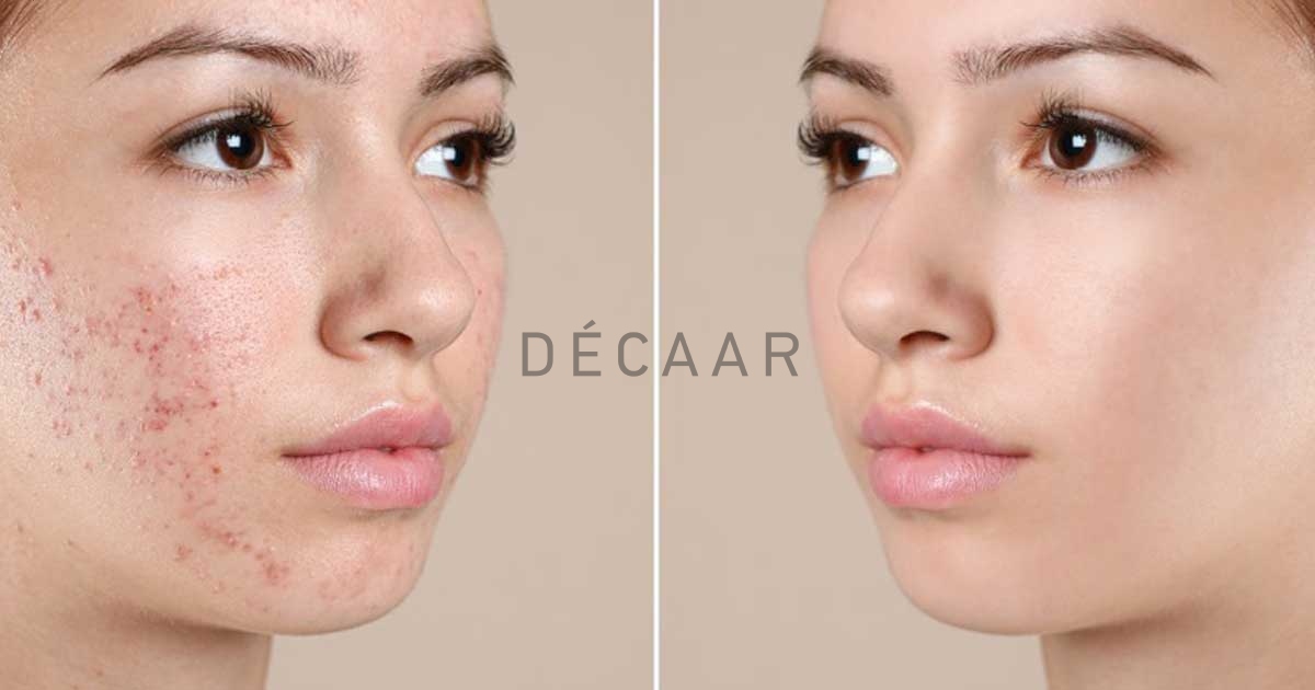 acid peel