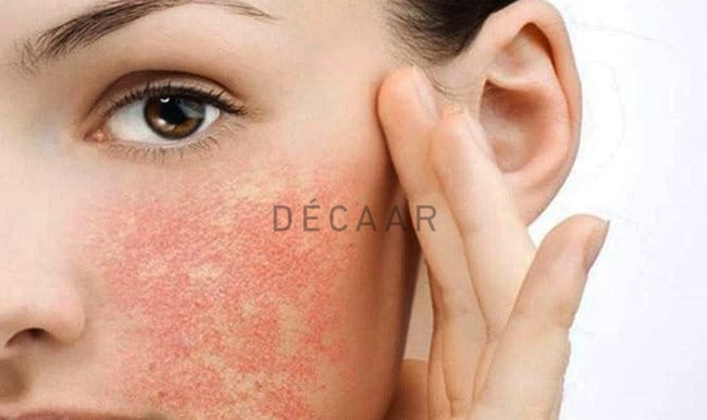 biến chứng sau peel da
