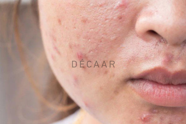 biến chứng sau peel da