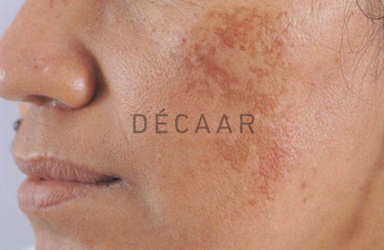 sắc tố melanin